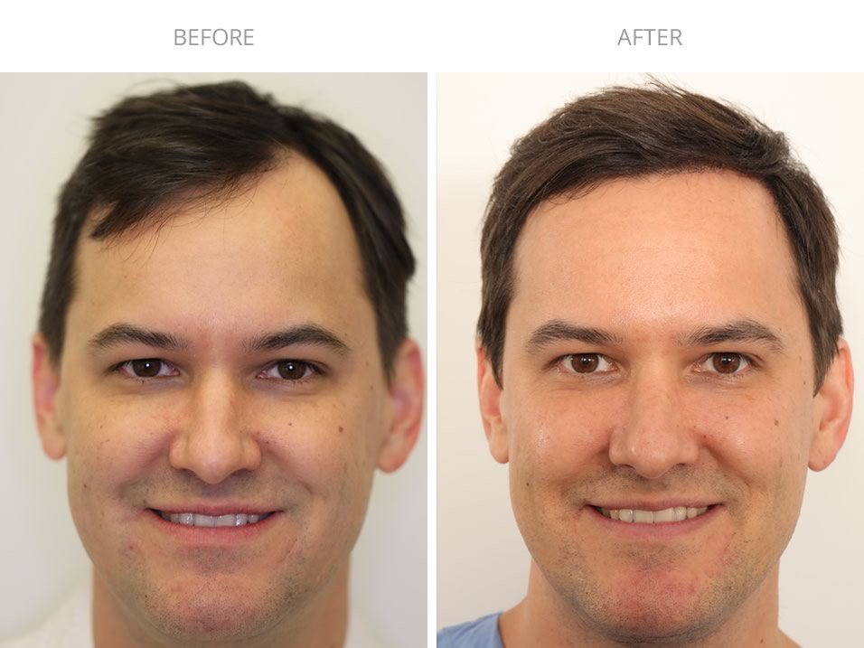 What to Look for When Choosing a Hair Transplant Surgeon in New York post thumbnail image