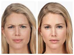 Exploring the Benefits of Botox Santa Barbara post thumbnail image