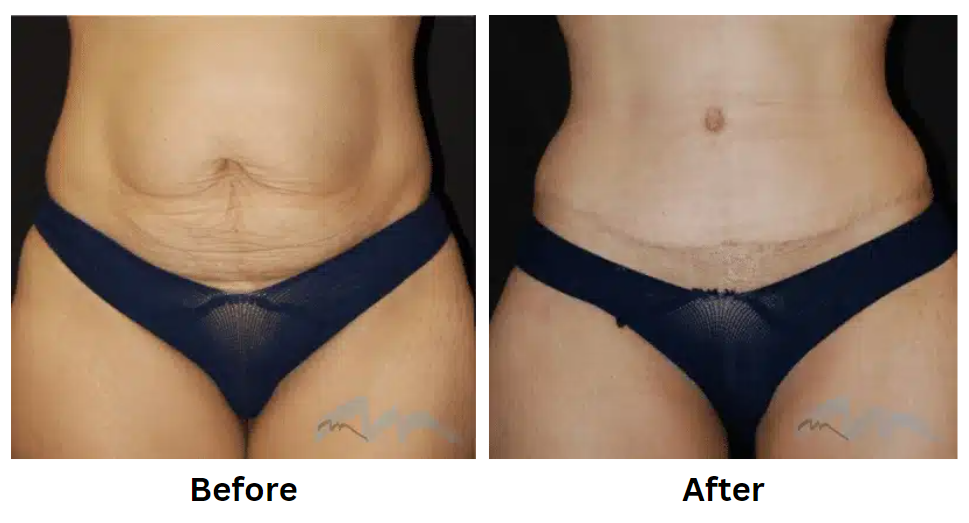 5 Advantages of Having an Abdominoplasty in Miami post thumbnail image