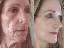 Skin Tightening Facial Near Me: Unveil Youthful Vibrance post thumbnail image