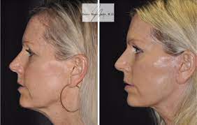 Classic Elegance: The ability of Facelift in Santa Barbara post thumbnail image