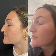 Unveiling Sciton Moxi: The Ultimate Skin Transformation post thumbnail image
